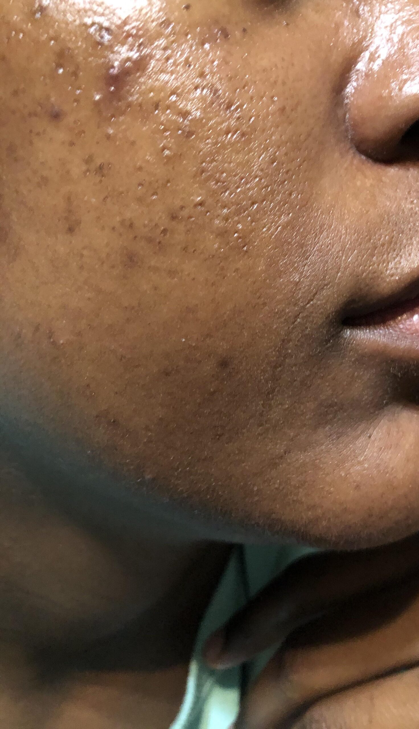 Combination skin