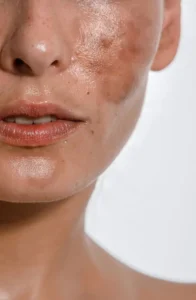 discoloration treatment