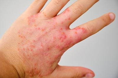 Eczema
