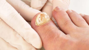 fungal infection treatment