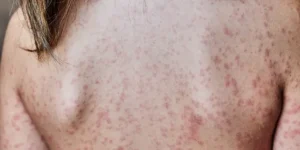 hives relief cream