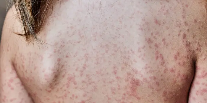 Hives (Skin Rash)