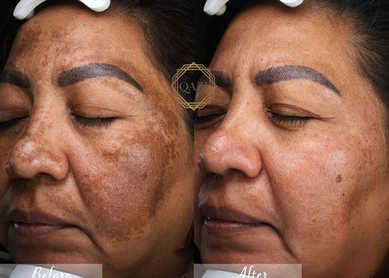 pigmentation