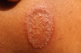 ringworm
