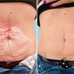 SKIN TIGHTENING