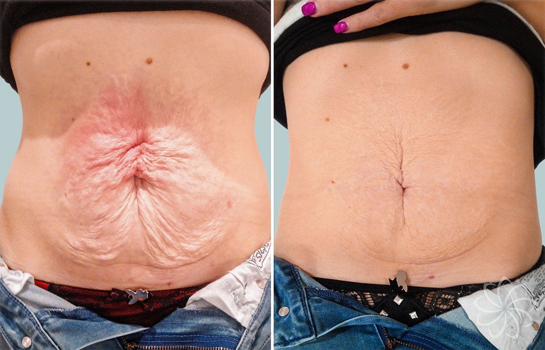 SKIN TIGHTENING