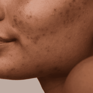 Sensitive skin