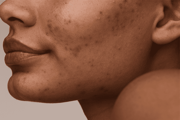Sensitive skin