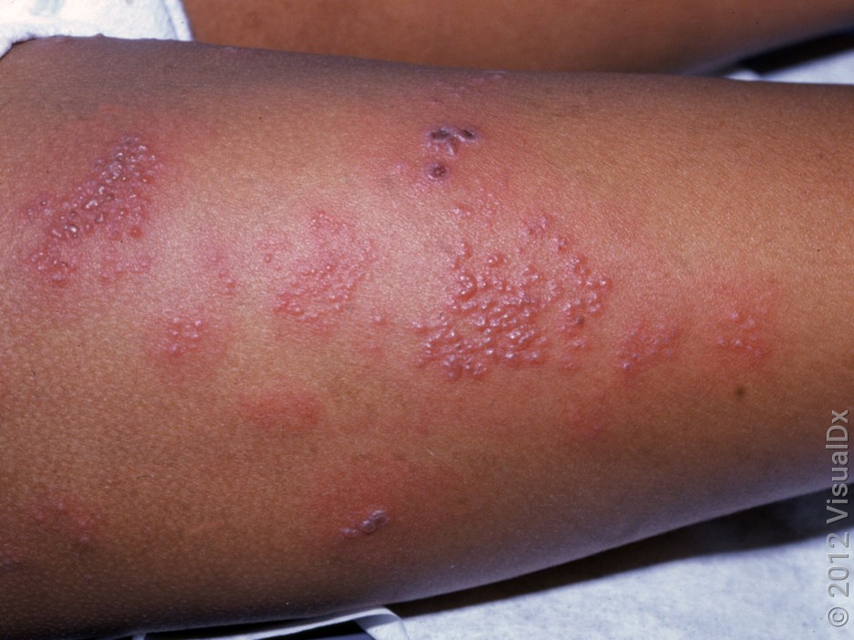 Shingles
