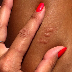 Stings and Bites