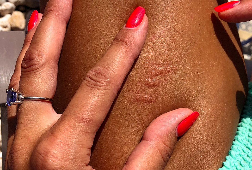 Stings and Bites