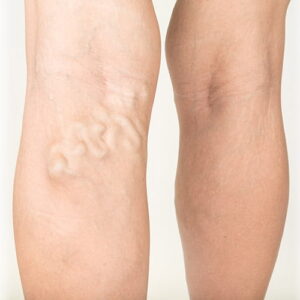 Varicos Veins
