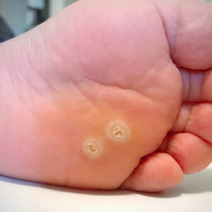 Warts