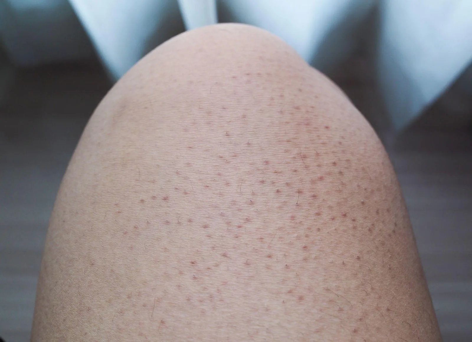 keratosis pilaris