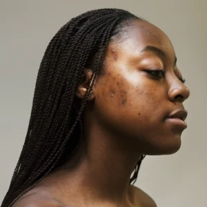 Skin conditions